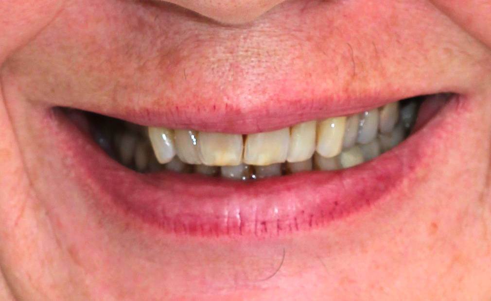 Depois do procedimento odontológico