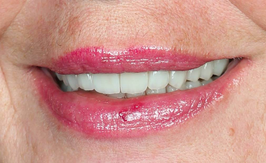 Antes do procedimento odontológico