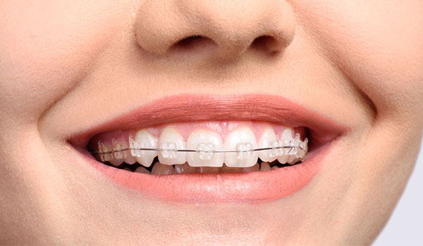 aparelho ortodôntico estético