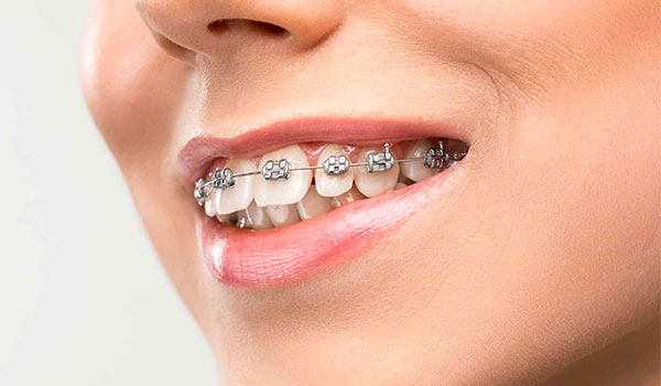 aparelho odontológico tradicional fixo