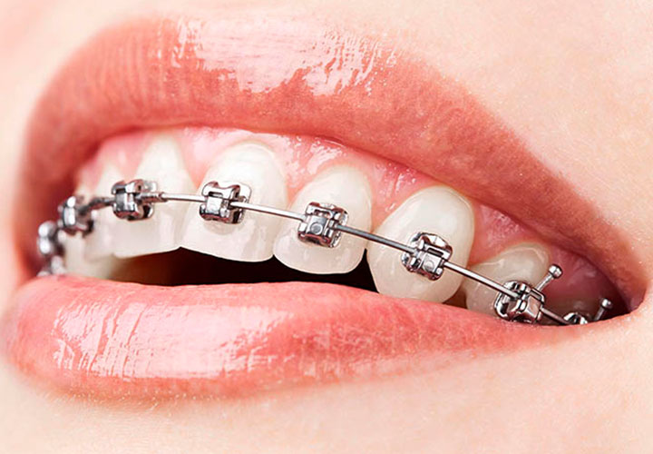 aparelho para os dentes