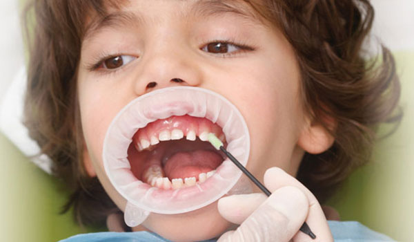 aplicação de flúor em crianças