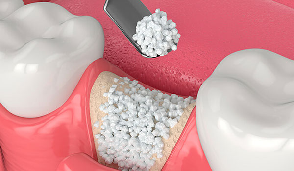 enxerto ósseo dentário