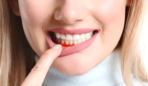 tratamento para gengiva sangrando