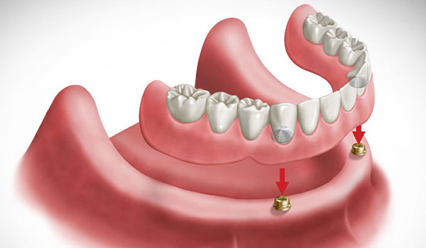 prótese dentária sobre implante