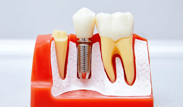 implante dentário unitário