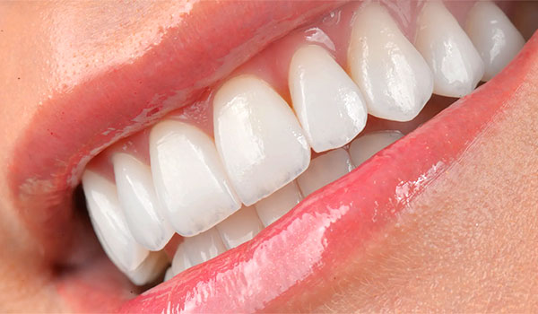 aplicação de lente de contato dental