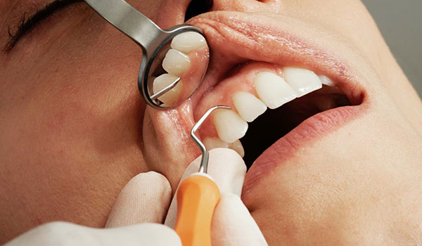 raspagem da gengiva para limpeza profunda