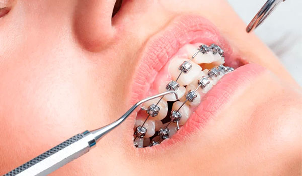 manutenção do aparelho ortodôntico