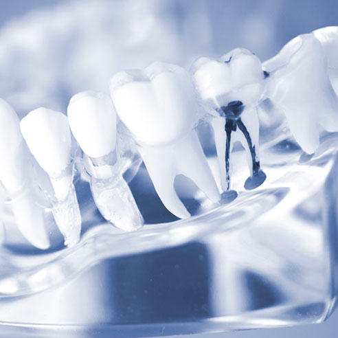 endodontia e tratamento de canal