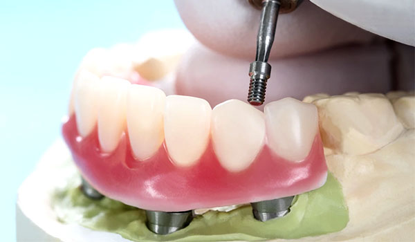 prótese protocolo dentadura fixa