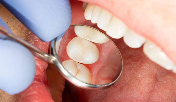 restauração de dente cariado