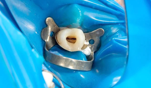 retratamento de canal