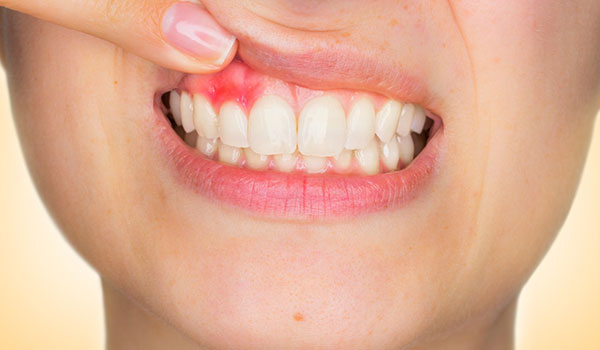 tratamento para a gengivite