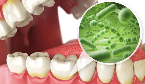 tratamento para infecção no dente