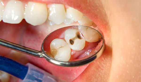 tratamento para dente com cáries