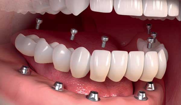 implantes múltiplos