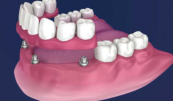 Overdenture (prótese removível sobre implantes)