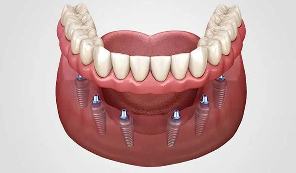 Protocolo fixo sobre implantes